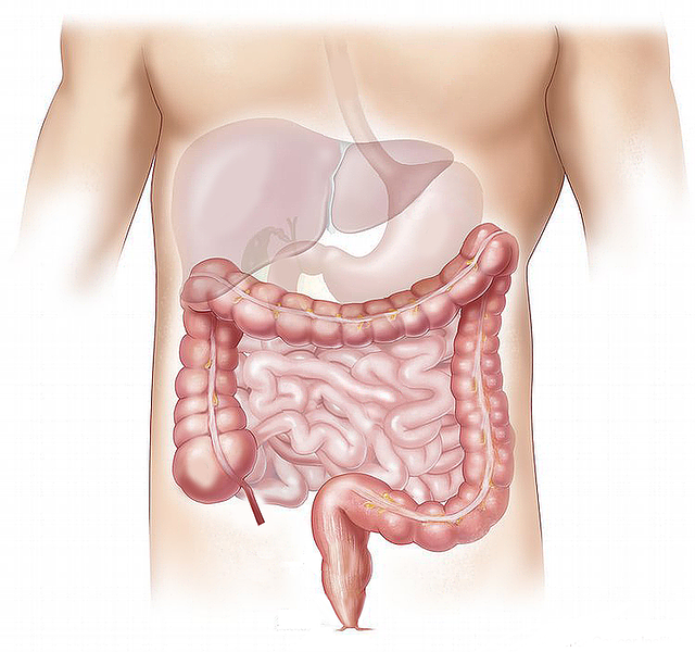 Câncer de cólon_intestino_colorretal